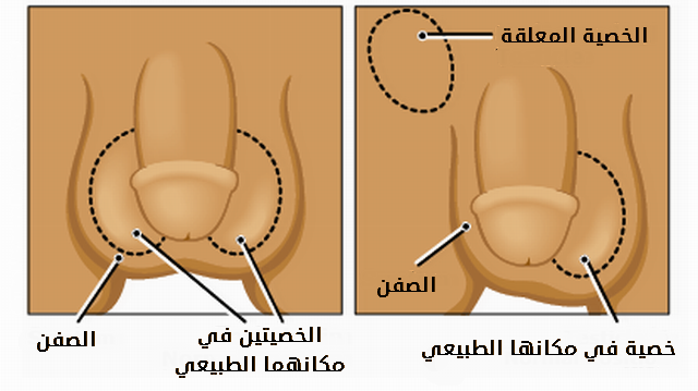 الخصية المعلقة الأعراض والعلاج