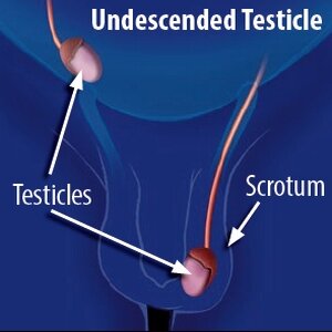 الخصية المعلقة undescended testicle