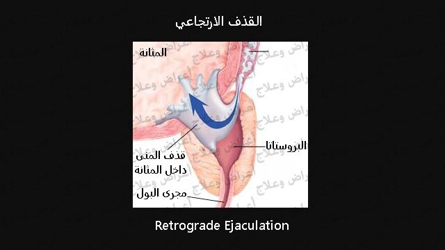 القذف الارتجاعي الأعراض والعلاج