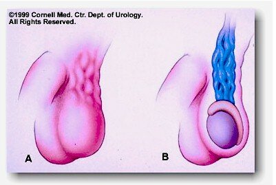 دوالي الخصية varicocele