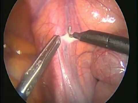 علاج دوالي الخصية جراحيا Varicocelectomy