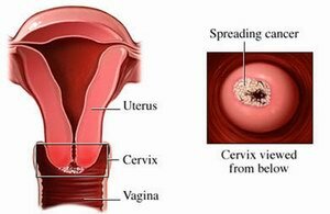 اعراض سرطان عنق الرحم, حقائق علمية عن اعراض سرطان عنق الرحم Cervical Cancer